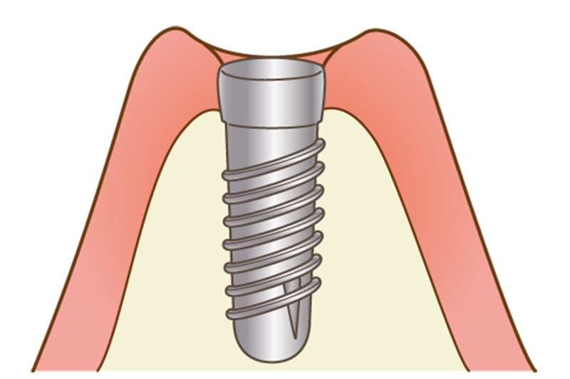 インプラント埋入（一次手術）