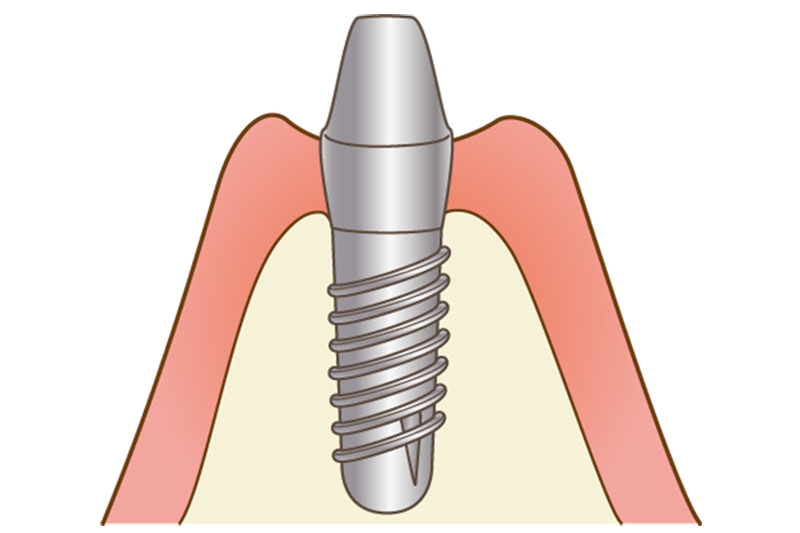 アバットメントの設置（二次手術）